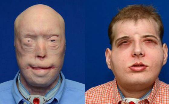 Лице назаем - пожарникар получава най-сложния лицев трансплант в света (видео)
