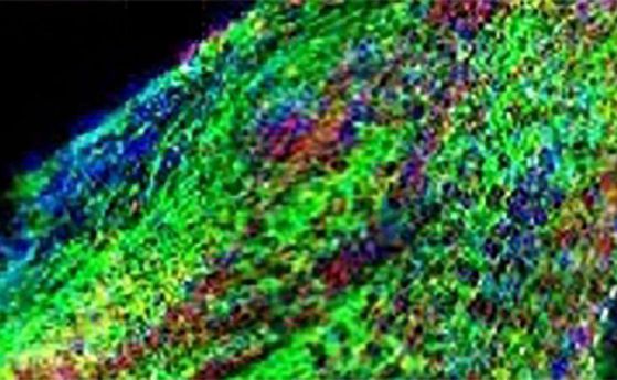 Терапия със стволови клетки лекува последиците от инсулта