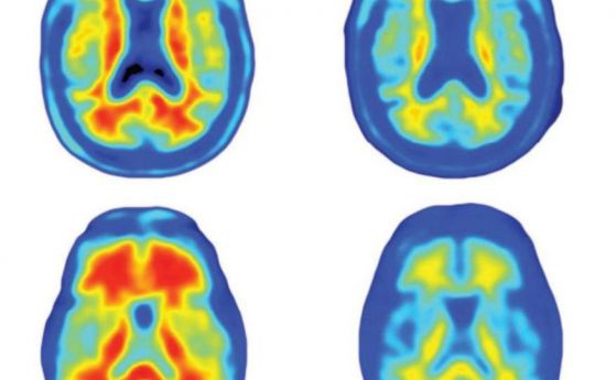 Ново лекарство показва безпрецедентен ефект при болестта на Алцхаймер (видео)