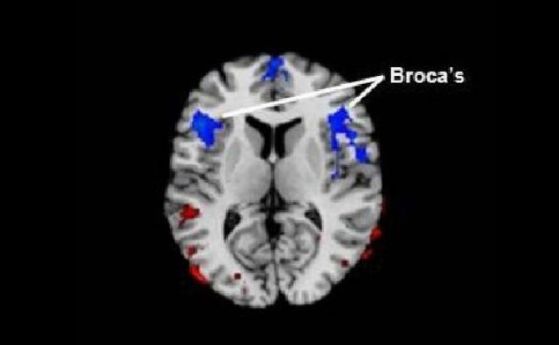 Заекването е свързано с намален приток на кръв в центъра на речта в мозъка
