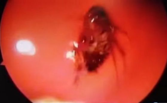 Лекари извадиха жива хлебарка от черепа на индийка (видео)