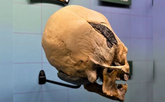 Древен хирургически имплант или съвременна фалшификация? Черепът от Перу остава загадка