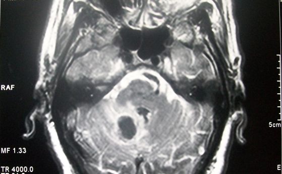 Магнитно-резонансно сканиране. Мозъчен кръвоизлив