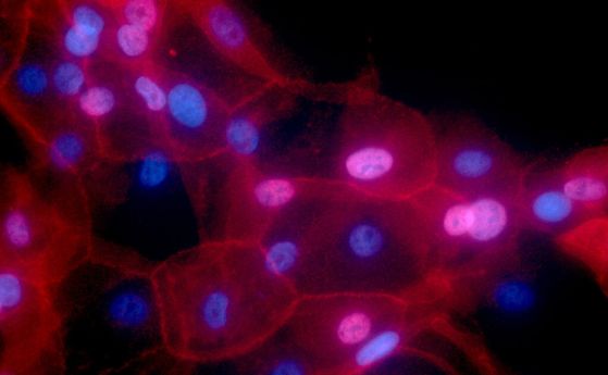 Светлинна микрография на клетки на рак на гърдата, които един ден биха могли да бъдат лекувани чрез насочване към специфични протеини на тяхната повърхност