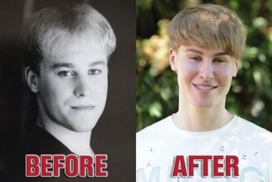 Тоби Шелдън преди и след операциите