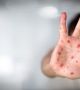 Украйна започва масова ваксинация срещу морбили