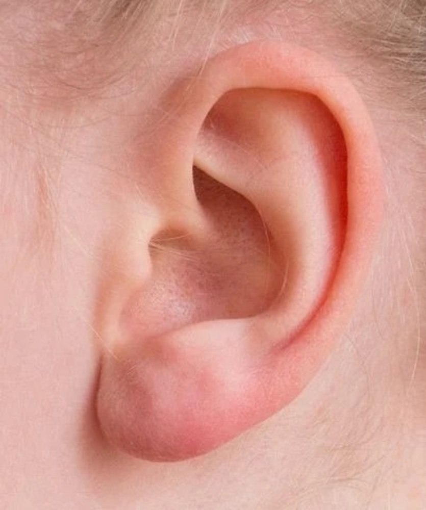 Американски медицински екип обяви че е имплантирал ухо отпечатано на