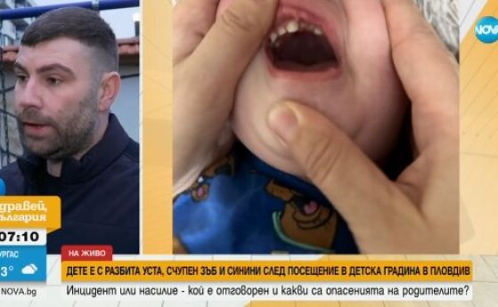 Дете на годинка е с разбита уста, счупен зъб и синини след посещение в образователен център в Пловдив