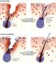 Как кожата се защитава от бъдещи увреждания: Как космите лекуват рани като използват епигенетичната си памет