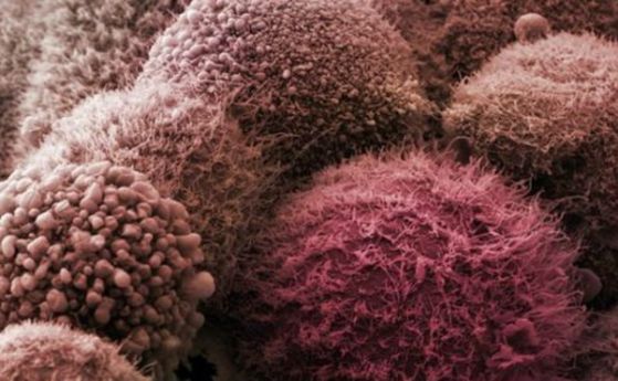 Ракът на панкреаса може да се диагностицира по анализ на урина