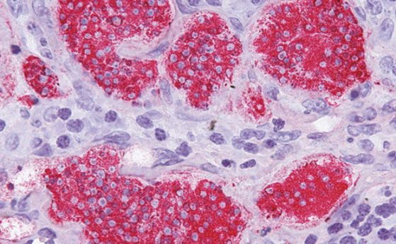 Регистриран е първия случай на заразяване на човек с рак от плосък червей
