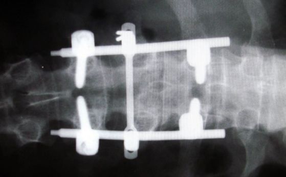 Учени са разработили ново устройство, което да понижава хроничните болки в гърба (видео)