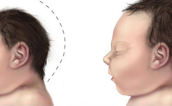 Пестициди, а не Зика, са причина за бебетата с малки глави, твърди доклад на арженстински учени