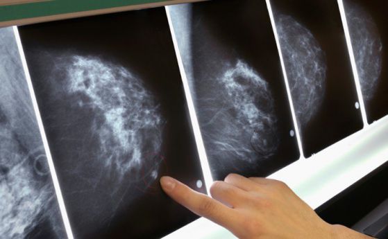 Ново лечение на рак на гърдата унищожава туморите само за 11 дни