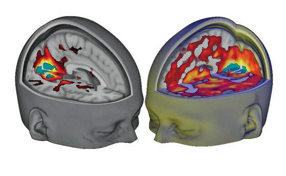 ЛСД прави човешкия мозък по-интегриран, показва уникално изследване (видео)