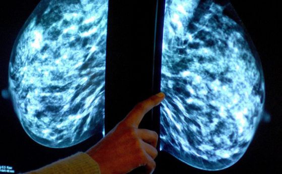 Хормонална терапия и рак на гърдата: Колко е реалният риск?