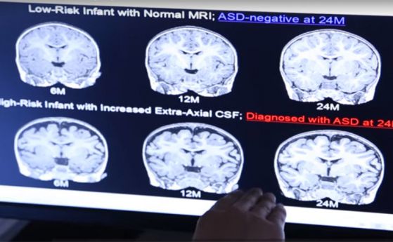 Изкуствен интелект засича аутизъм още от 6-месечна възраст