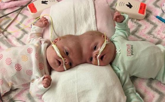 Хирурзи успешно разделиха сиамски близнаци с една глава
