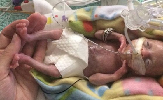 Най-недоносеното бебе в света стана на 3 години