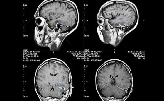 Ужасна инфекция в мозъка бе предизвикана от клечки за уши