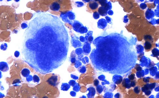 Патолог: Аутопсиите на случаи с COVID-19 откриват кръвни съсиреци в почти всеки орган
