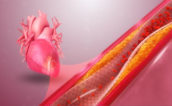Интензивните упражнения предизвикват калцирането на коронарните артерии
