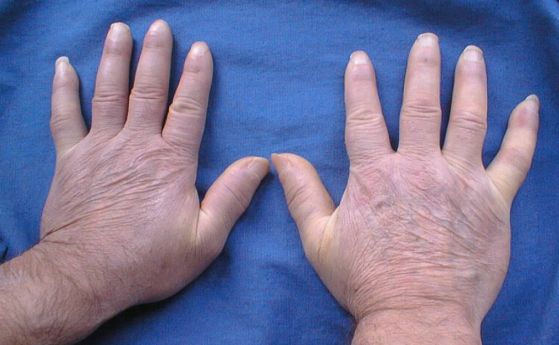 Първата в света двойна трансплантация на ръце за пациент със склеродермия