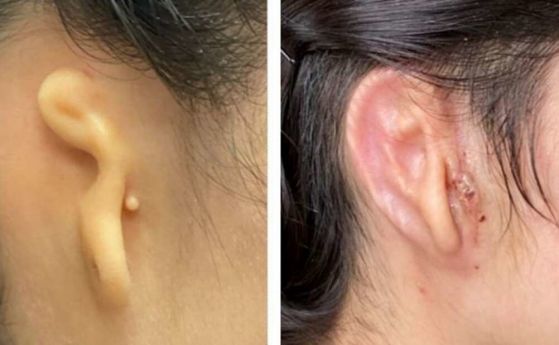 Успешно е имплантирано 3D отпечатано човешко ухо 