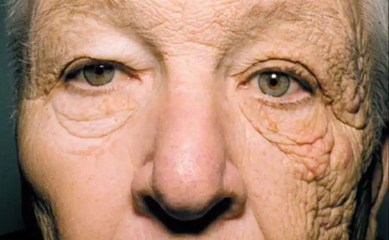 Набръчканата лява страна на лицето на Уилям МакЕлигот след излагане на слънце