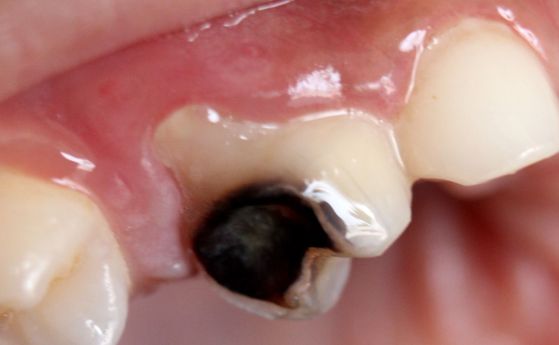 Макроснимка на развален зъб