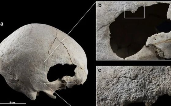 Жена от медната епоха е преживяла две операции на черепа преди 4500 години