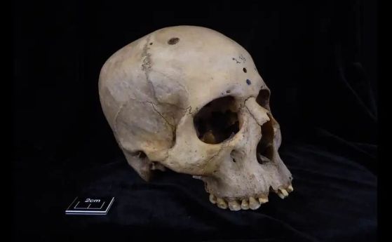 Древноегипетски череп показва най-стария известен опит за лечение на рак