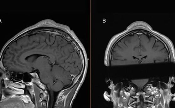 две магнитно-резонансни изображения на главата на човек, показани отстрани и след това отзад. И от двата ъгъла се вижда голяма буца в горната част на черепа