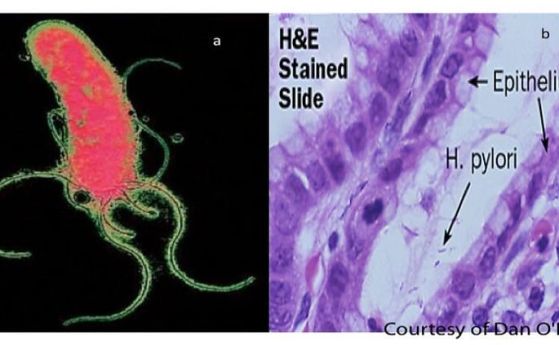 Helicobacter pylori.