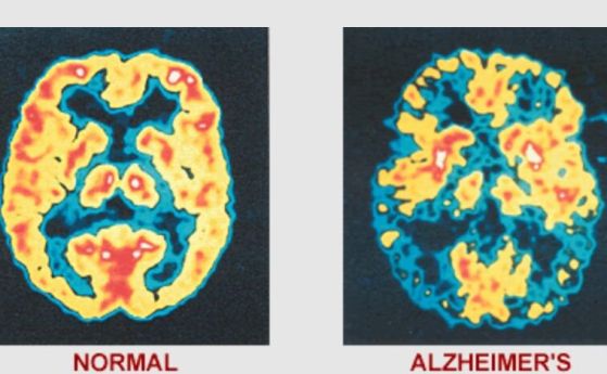 Вляво: позиционна емисионна томография (РЕТ) на нормален мозък, вдясно - на мозък, поразен от Алцхаймер