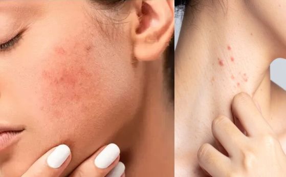 екзема по лицето и шията