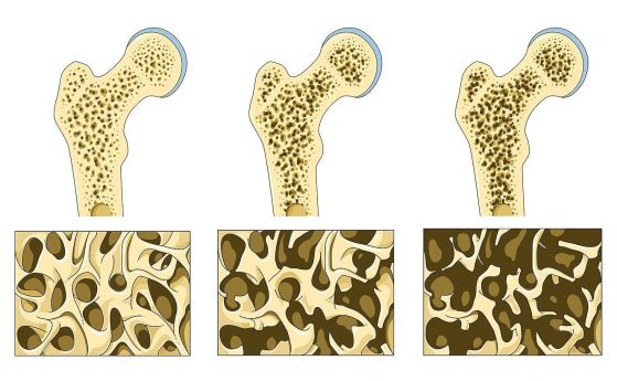 остеопороза