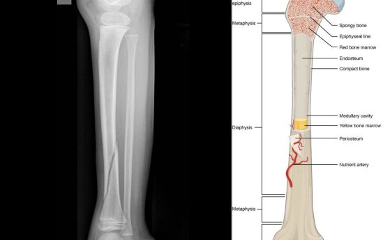 Вляво: снимка на костна фрактура, вдясно: анатомия на тибия 