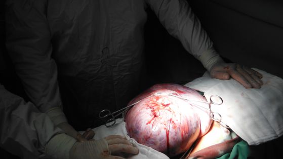 Гинеколозите от "Пирогов" извадиха от млада жена 13-килограмова киста