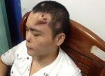 Китаец живее с нос на челото си (снимки)