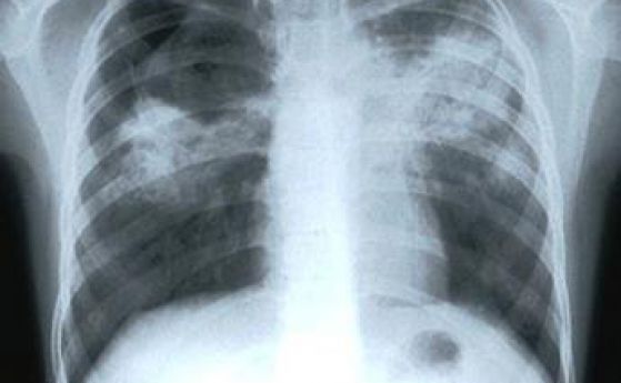 1871 болни от туберкулоза българи през 2014 г.