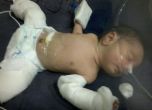 Лекари премахнаха недоразвит брат близнак от корема на бебе