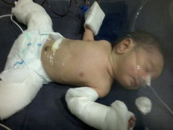 В стомаха на бебе от Индия лекари са открили негов