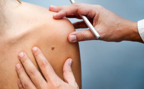 Какво е рак на кожата Защо е толкова важно навременното