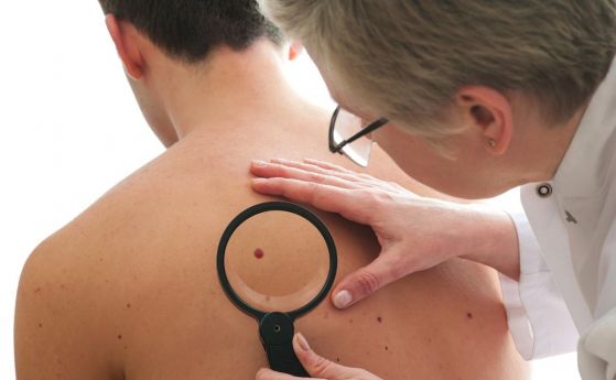 Какво е меланомът и какви са ранните признаци на рака на кожата?