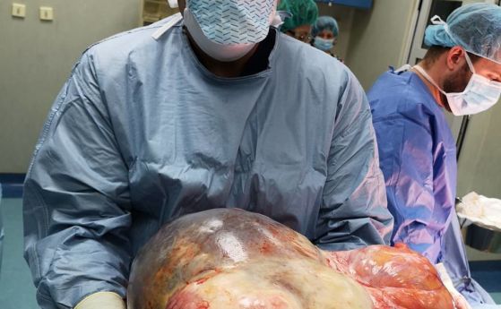 18 килограмов тумор от корема на 50 годишна жена отстраниха специалистите от