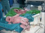 Лекари от Майчин дом спасиха родилка и близнаците ѝ, акушерките я изненадаха за рождения ден