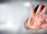 Нови 6 случая на заразени с морбили в Пернишко само за седмица