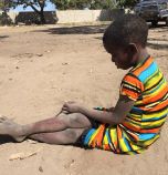 За първи път след 30 години: дете се разболя от полиомиелит в Мозамбик