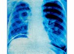 Омега-3 мастните киселини могат да забавят фатално увреждане на белите дробове